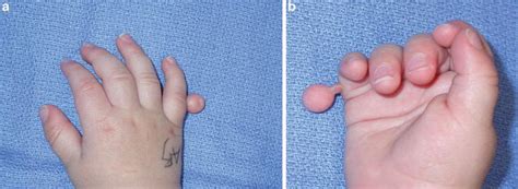 Ulnar Polydactyly and Ulnar Dimelia | Plastic Surgery Key