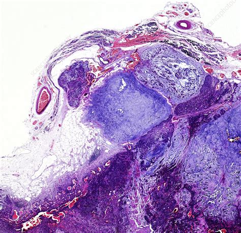 Pleomorphic adenoma of the parotid gland, light micrograph - Stock ...