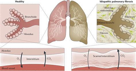 Pulmonary fibrosis causes, types, symptoms, diagnosis, stages & treatment