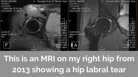 Why your hip labral tear diagnosis shouldn’t scare you.