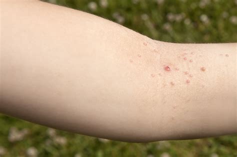 Molluscum Contagiosum: Symptoms and Treatment - Cache Valley Family ...