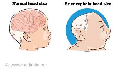 Anencephaly