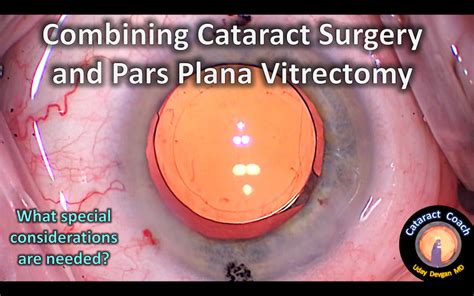 Cataract Surgery and Pars Plana Vitrectomy – Cataract Coach