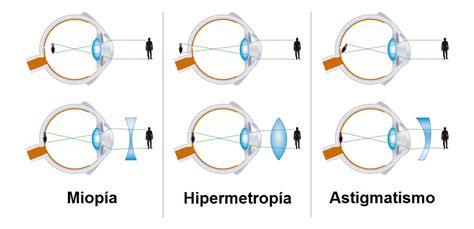 AMETROPIAS MIOPIA HIPERMETROPIA ASTIGMATISMO PRESBIOPIA - Neovisão