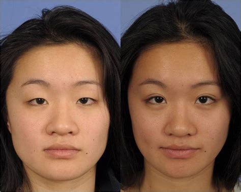 Skin Tightening http://gartnerplasticsurgery.com/contact/ | Nose ...