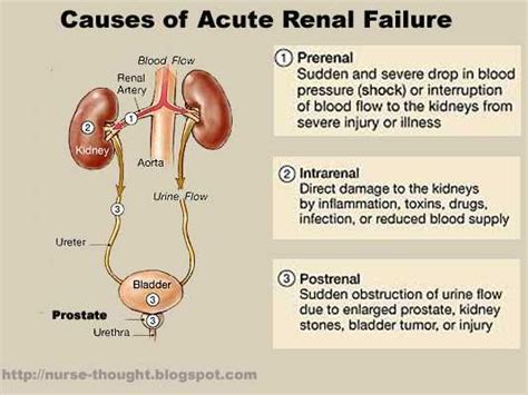 http://renalcalculi.net/acute-renal-failure.html Serious kidney ...