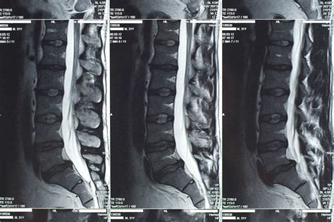 Should You Get an MRI for Your Back Pain - Holland Park Osteopaths