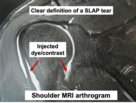 What is a Shoulder MRI arthrogram?