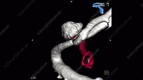 Brain aneurysm repair, 3D CT scan - Stock Video Clip - K005/5746 ...