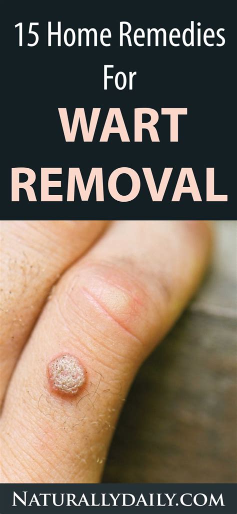 15 Home Remedies for Warts – Easy Home Wart Treatments ...