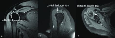 Supraspinatus Tendon Tear MRI