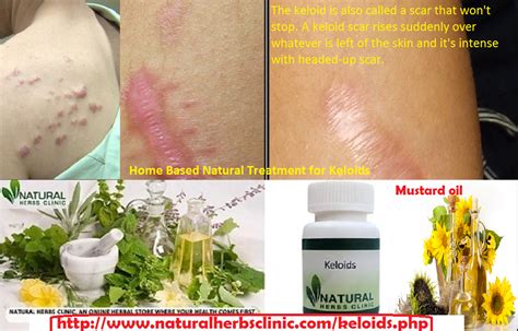 Keloid Treatment at Home