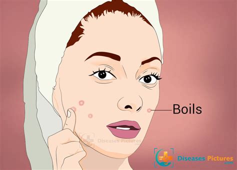 Boils (Skin Abscess) – Symptoms, Causes, Treatment, Prevention | #site ...