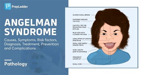 Angelman Syndrome: Causes, Symptoms, Risk Factors, Diagnosis, Treatment ...