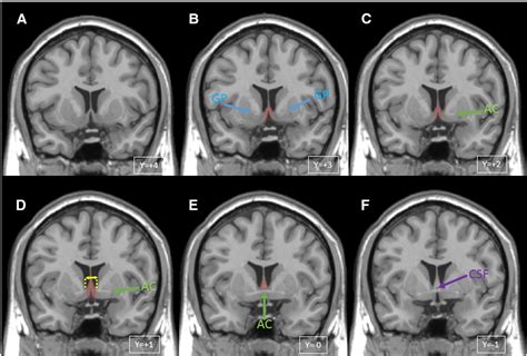 Figure 2 from Comparison of human septal nuclei MRI measurements using ...