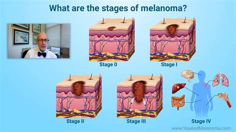 What are the stages of melanoma? - YouTube