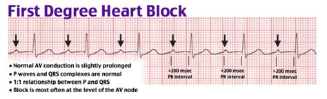 First Degree Av Block
