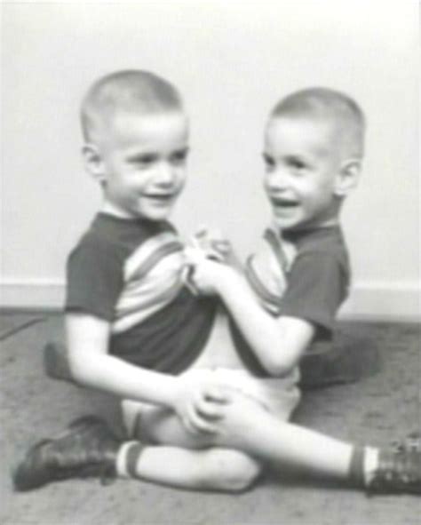 World’s longest-surviving conjoined twins Ronnie & Donnie Gaylon who ...