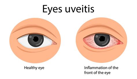 Uveitis Guide: Types, Symptoms, Causes, and Treatments | MyVision.org