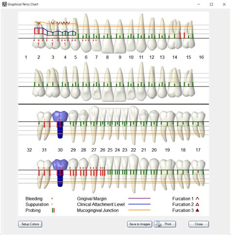 How To Do Periodontal Charting - Best Picture Of Chart Anyimage.Org