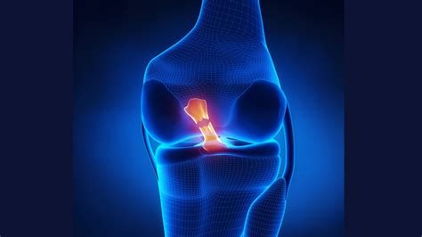 Symptoms of a Torn ACL, What to do at Home