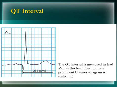 Basics of ECG - online presentation