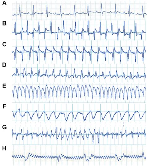 Electrocardiogram (ECG) tracings of rats with ventricular arrhythmias ...