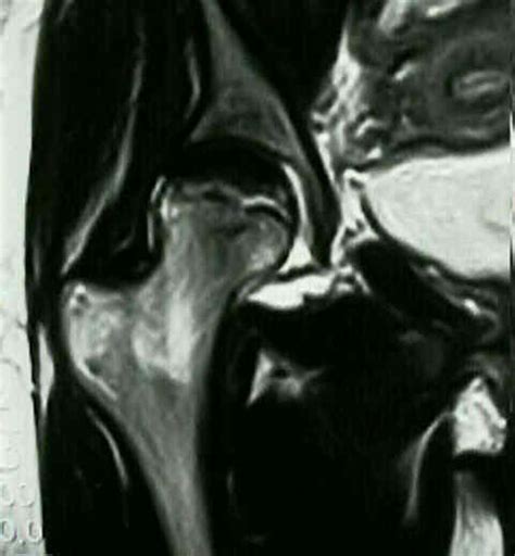 MRI of AVN of Femoral Head : Wheeless' Textbook of Orthopaedics