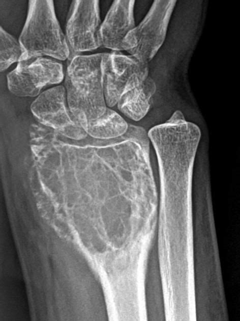 Giant cell tumour of bone | Radiology Reference Article | Radiopaedia ...