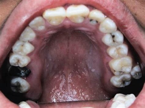 Case 4: supernumerary tooth (paramolar) associated with talon cusps ...