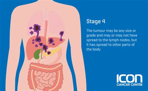 What is Soft Tissue Sarcoma? Soft Tissue Sarcoma Explained — Icon ...