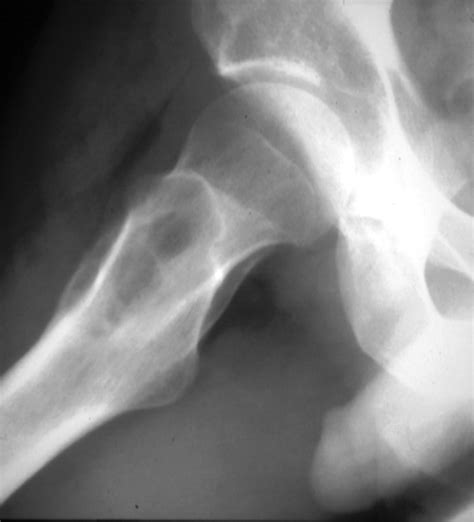 Osteoblastoma Spine