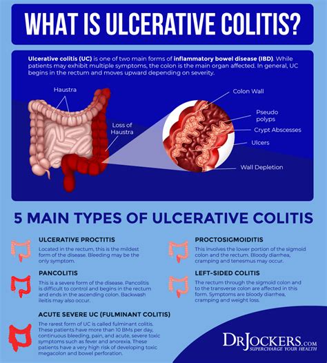 Ulcerative colitis causes symptoms and natural support strategies – Artofit