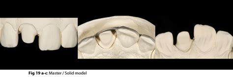 Morphology: Traditional Wax-up Technique for Anterior and Posterior ...