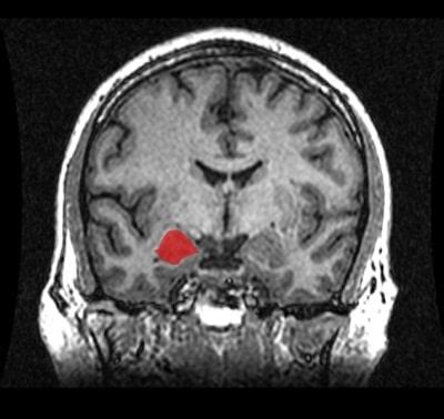 Size, Connectivity of Brain Region Linked to Anxiety Level in Young ...