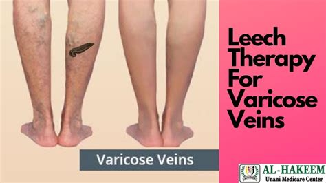 Leech Therapy For Varicose Veins | Successful Treatment - YouTube