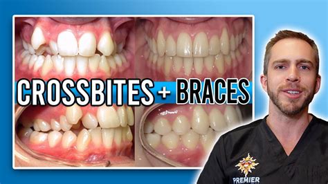 Build A Info About How To Fix Crossbite - Assistancecorporation