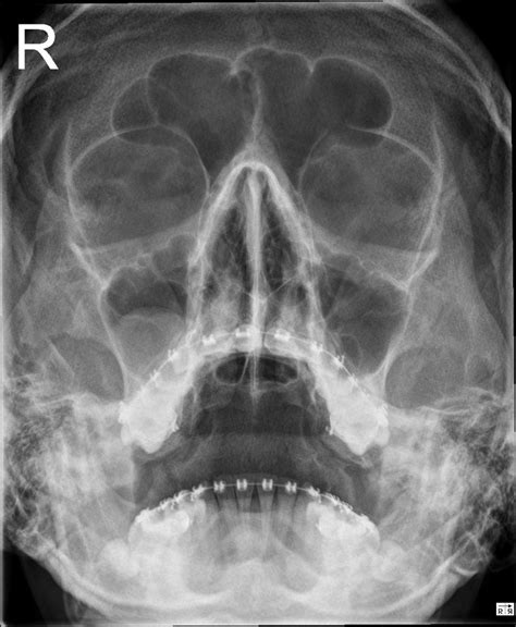 MUCOUS RETENTION CYSTS OF MAXILLARY SINUS | Buyxraysonline