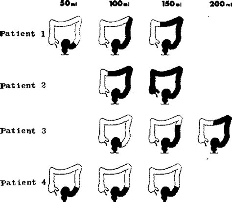 Figure 3 from The Longer-Term Evaluation of Rubber-Band Ligation ...