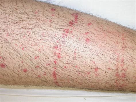 Petechiae - Pictures, Causes, Diagnosis, Treatment and Cure