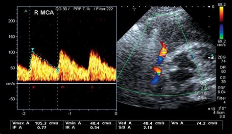 Use of transcranial doppler ultrasonography in the pediatric intensive ...