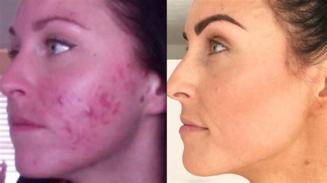 Blogger Juli Bauer Roth Shares Cystic Acne Before and After Photos | Allure