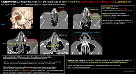 Frontal Process Of Maxilla Fracture