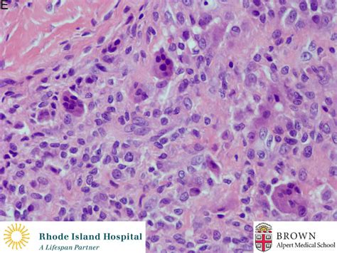 Giant Cell Tumor Histology