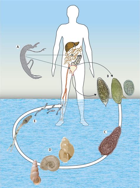 Human schistosomiasis - The Lancet