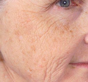 Age & Liver Spots Treatment Toronto | Fairview Laser Clinic Inc.