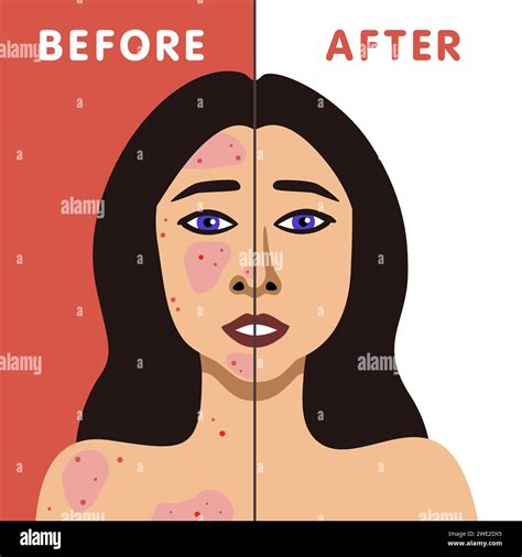 Vector image of a fair woman before and after acne skin treatment ...