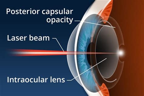 Yag Laser Capsulotomy - Tanner Eyes