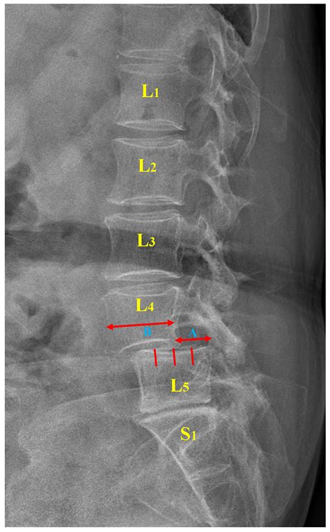 Spondylolisthesis Grade