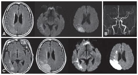 A: Brain MRI on admission shows an acute right parietal lobe infarction ...